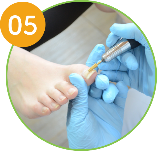 特殊な技術で痛みのない巻き爪補正