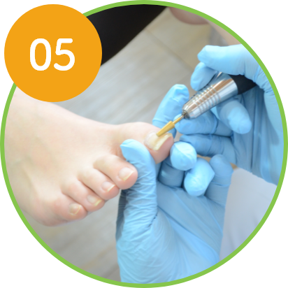 特殊な技術で痛みのない巻き爪補正